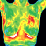 Breast thermography heat map