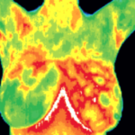 Thermal breast scan showing heat variations