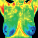 Thermal scan of chest and breasts